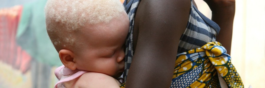 Mozambique host first forum to fight trafficking of people with albinism in Southern Africa