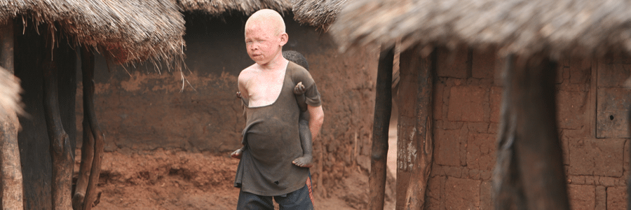 Attacks on persons with albinism decline; local attitudes must change Attacks on persons with albinism decline; local attitudes must change