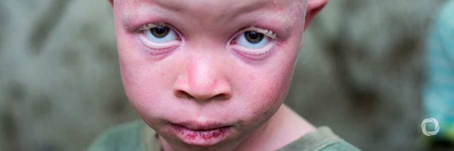 Kenya makes progress in supporting people with albinism, but ‘much remains to be done’ Kenya makes progress in supporting people with albinism, but ‘much remains to be done’