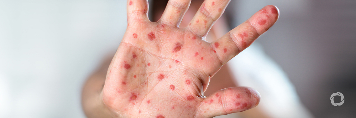 Measles in Europe: infection rates highest in a decade Measles in Europe: infection rates highest in a decade