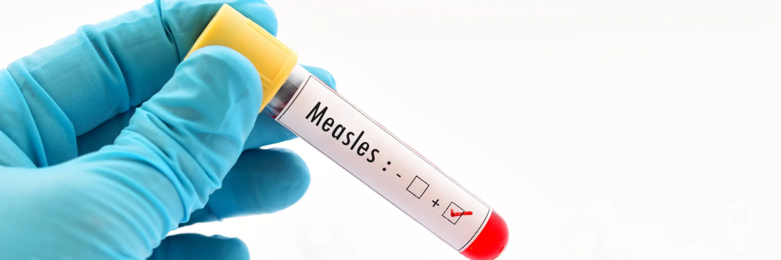 UK medics fight deadly measles outbreak in Samoa UK medics fight deadly measles outbreak in Samoa