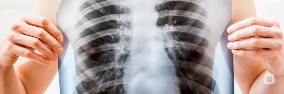 Tuberculosis—good progress, but not enough