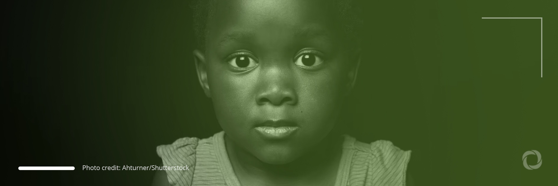 Noma, deformed face of children’s poverty Noma, deformed face of children’s poverty