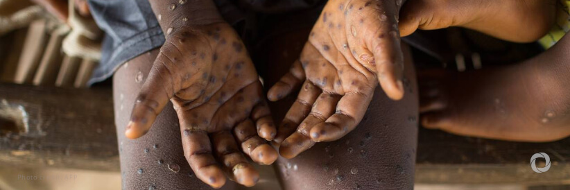 Monkeypox transmission may have gone undetected ‘for some time’ Monkeypox transmission may have gone undetected ‘for some time’