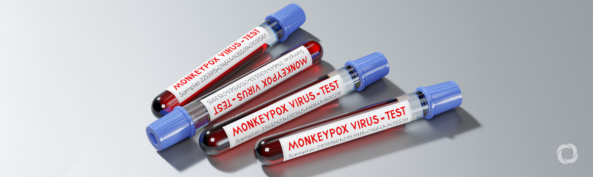 Could monkeypox become a threat leading to another pandemic? | Associate Writer