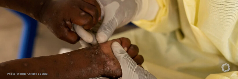 Children at severe risk of death from mpox Children at severe risk of death from mpox