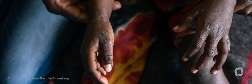 UNICEF appeals for US$58.8 million to address mpox crisis as cases among children rise