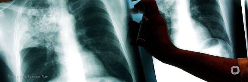 Funding cuts jeopardize global fight against tuberculosis, WHO warns