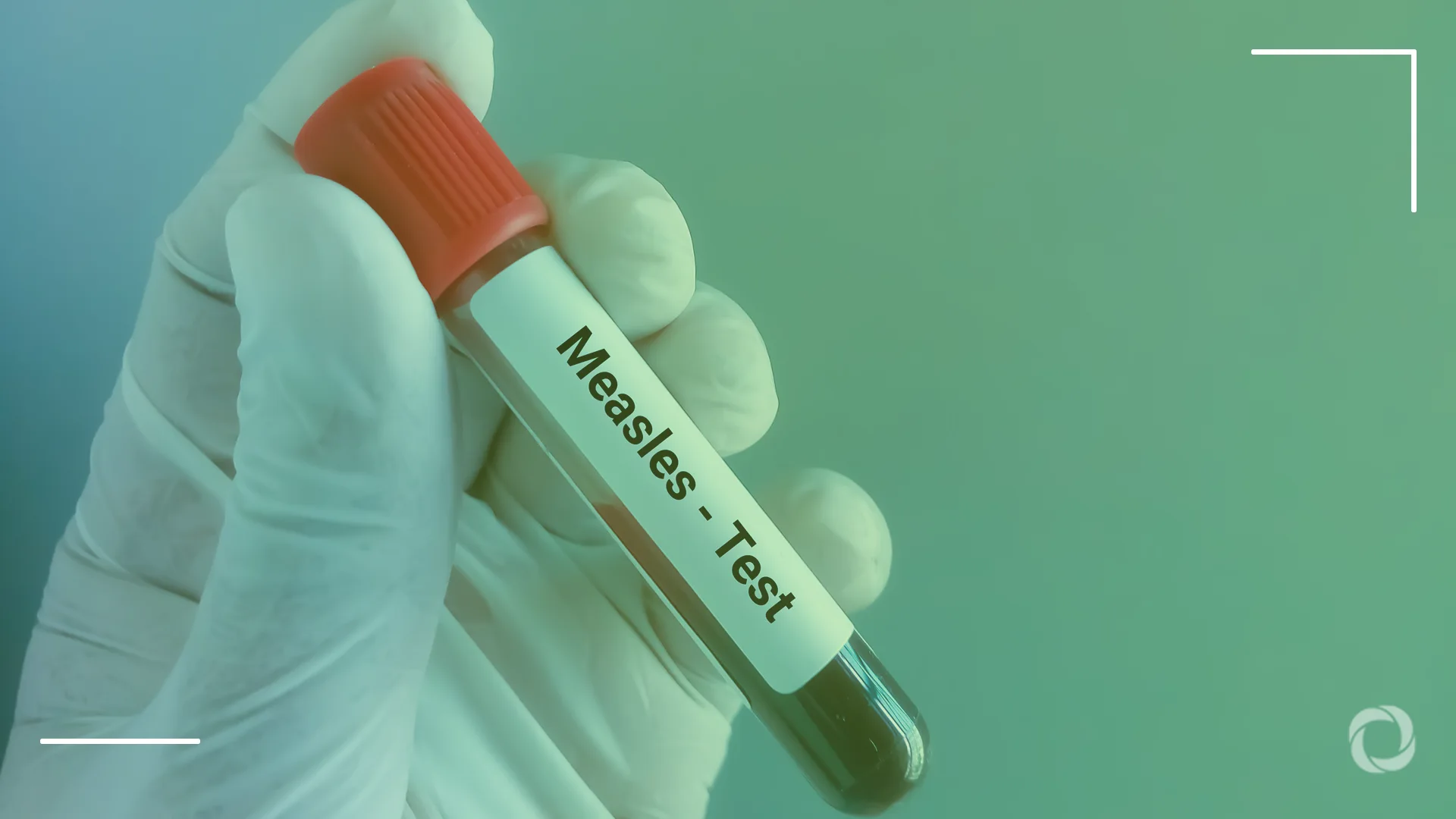 Once-eliminated measles resurges across Europe and North America