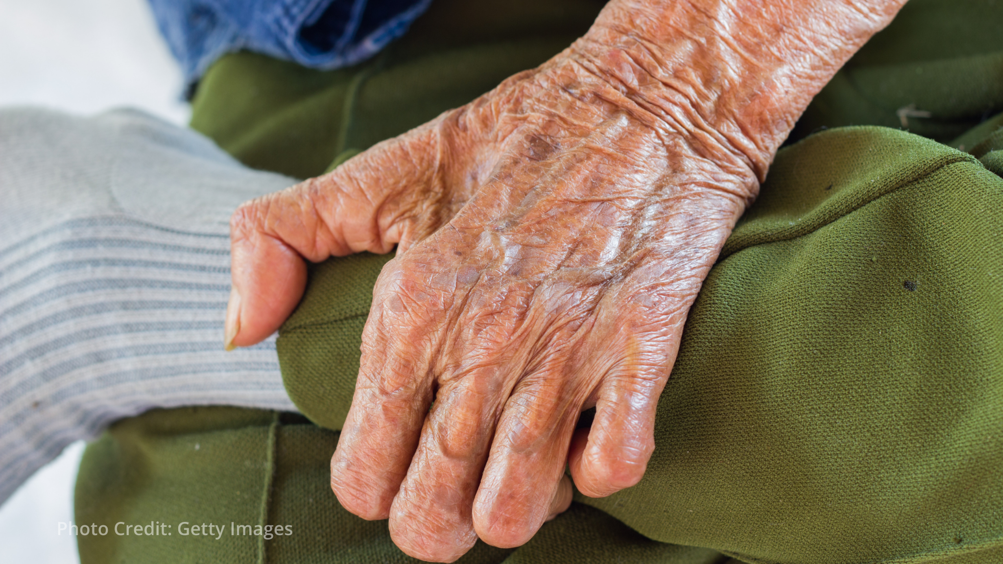 Chile becomes first country in the Americas to eliminate leprosy Chile becomes first country in the Americas to eliminate leprosy