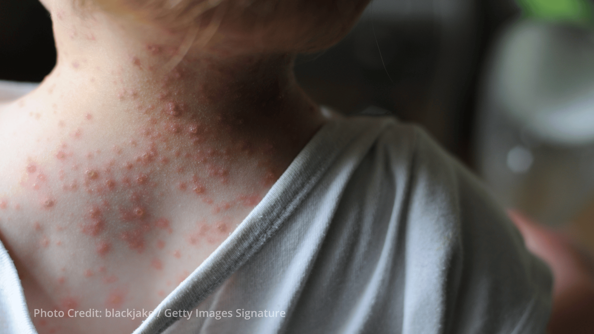 Global initiative launched to improve access to mpox vaccines